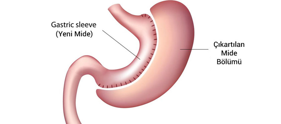 Tube Stomach Surgery (Sleeve Gastrectomy)